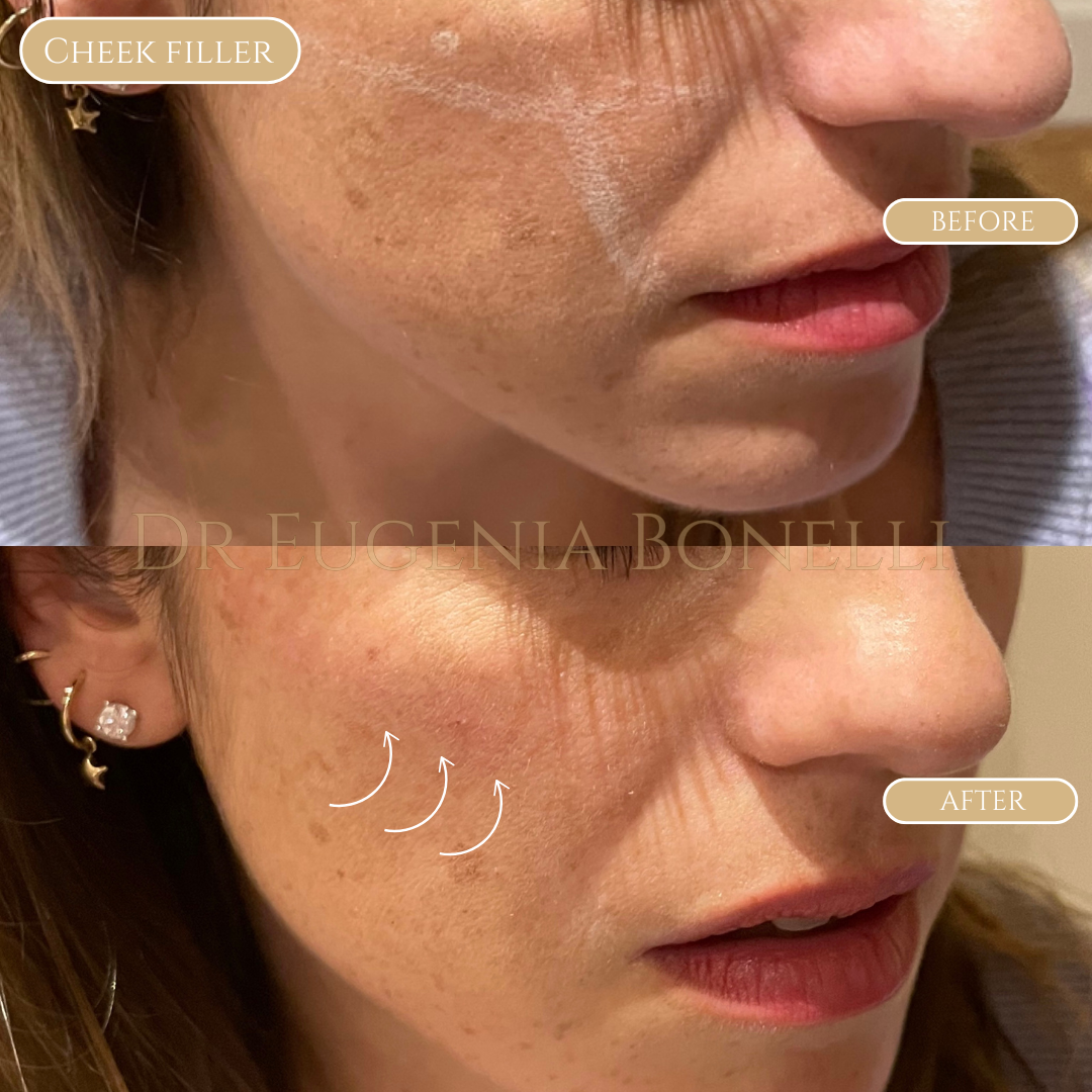cheek filler 2