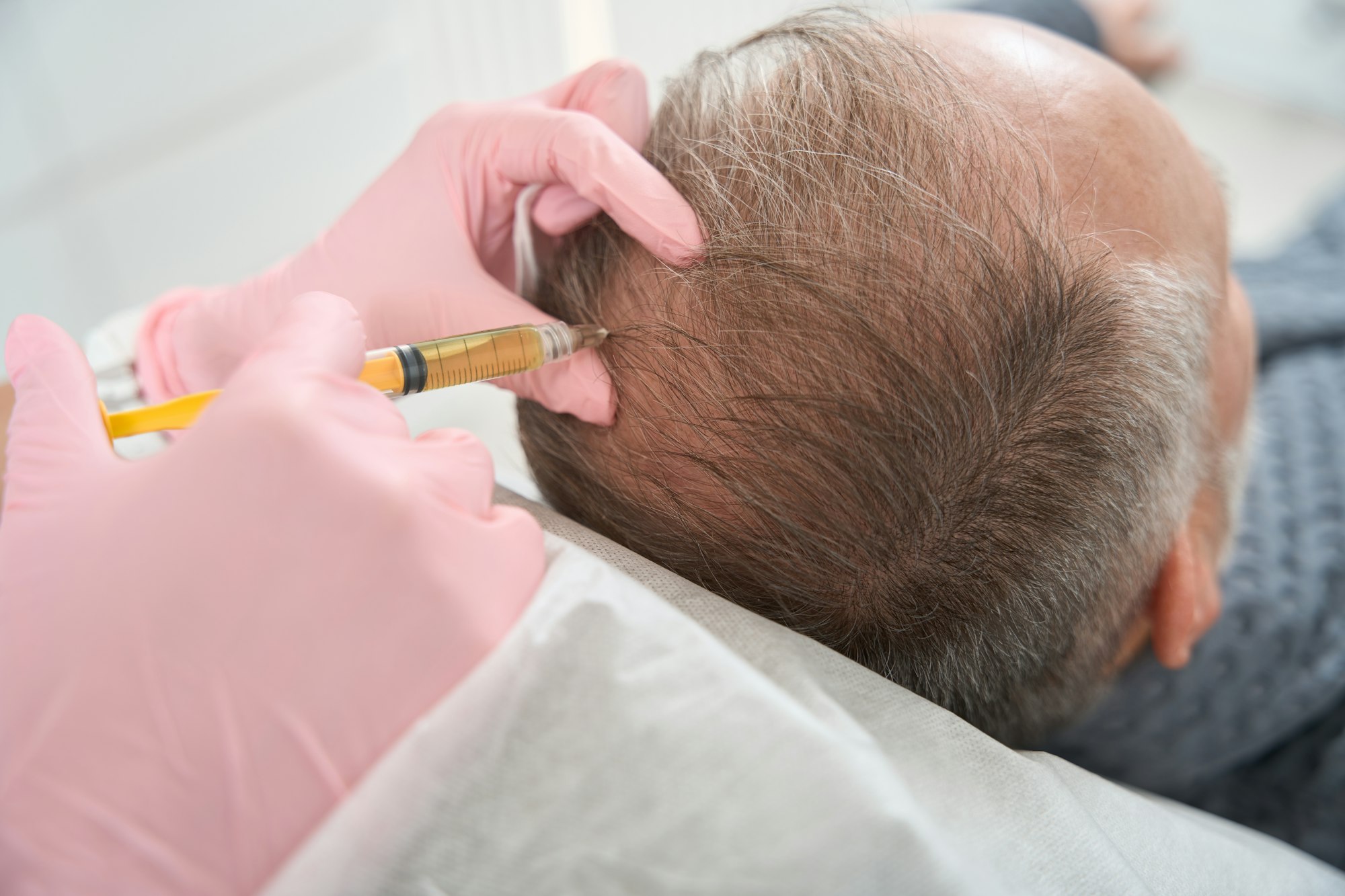 Doctor makes injections in the scalp to the patient