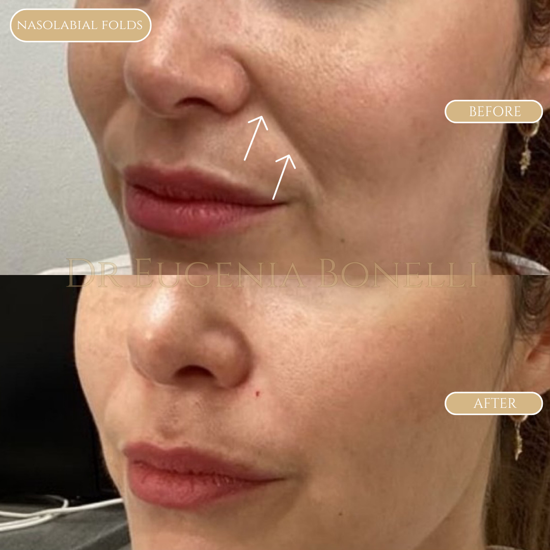 lip fillers 1