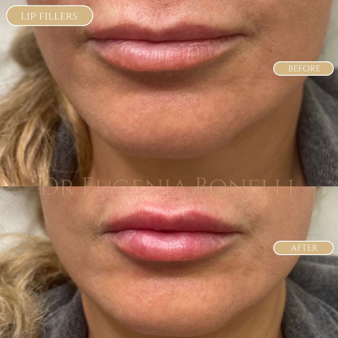 lip fillers 5