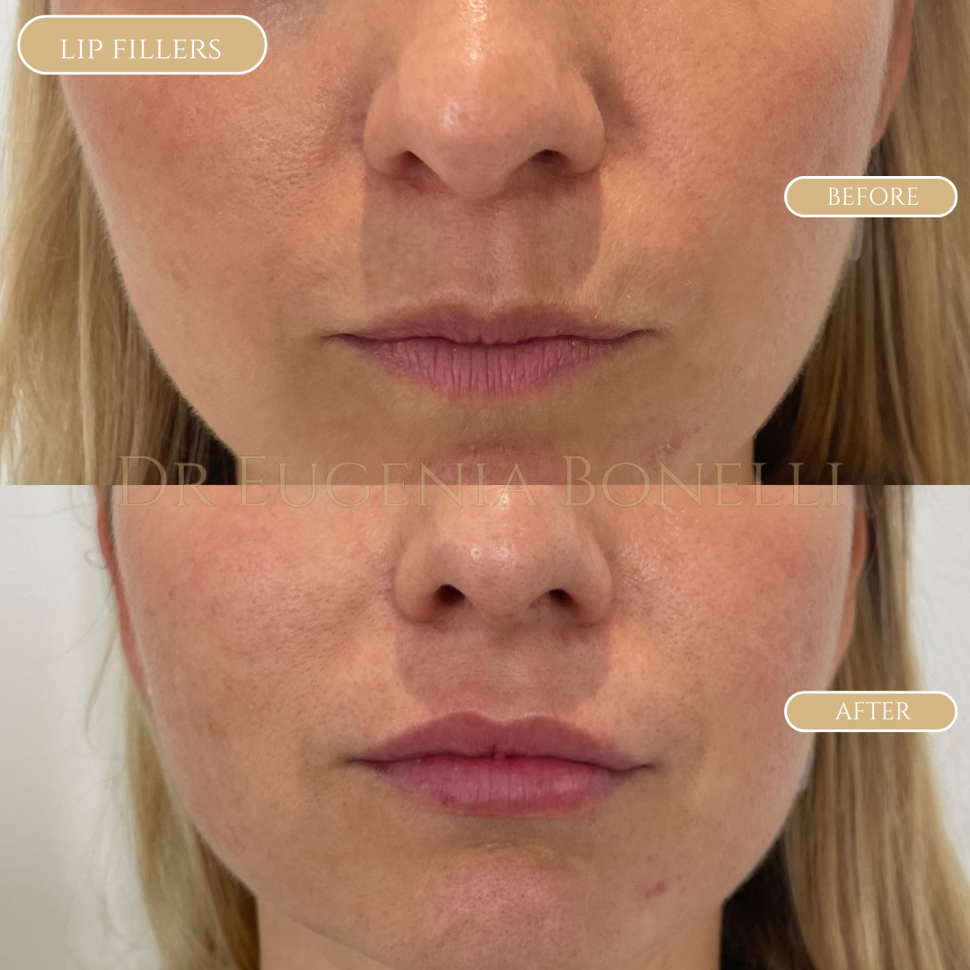 lip fillers 7
