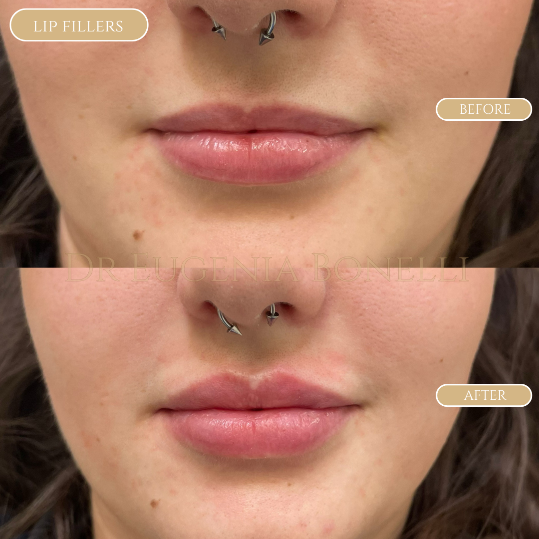 lip fillers 8
