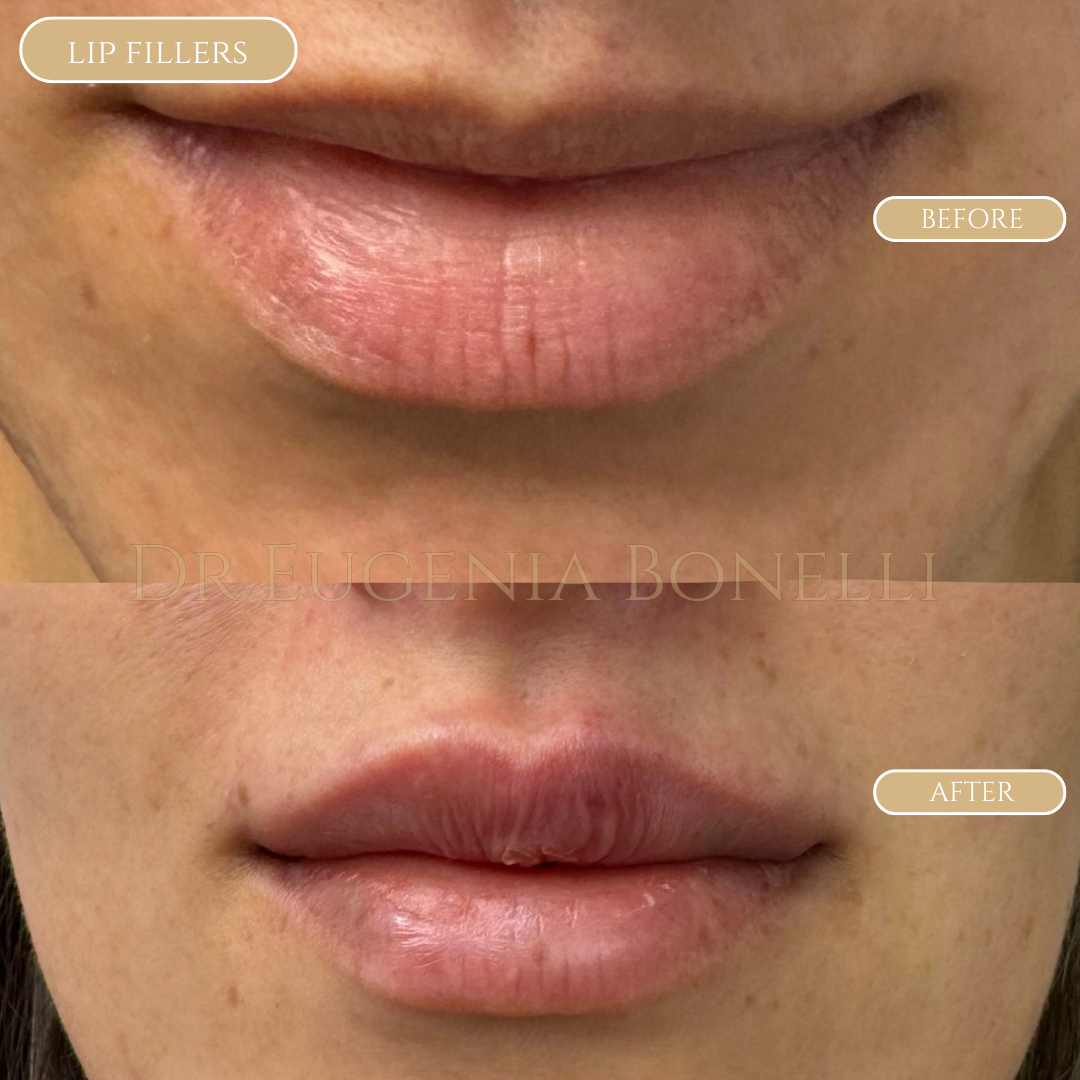 lip fillers 9