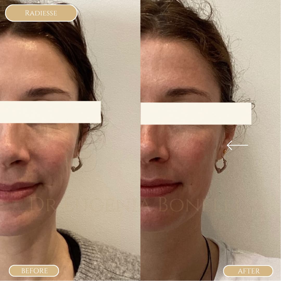 radiesse b&a